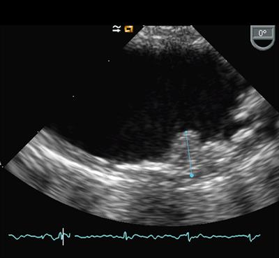 Aortic Sources of Embolism